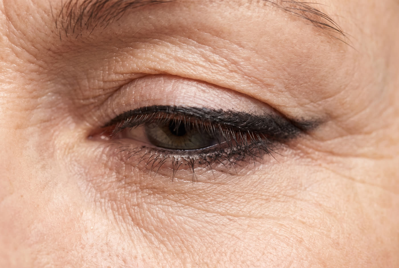 A hard dark line around the whole eye